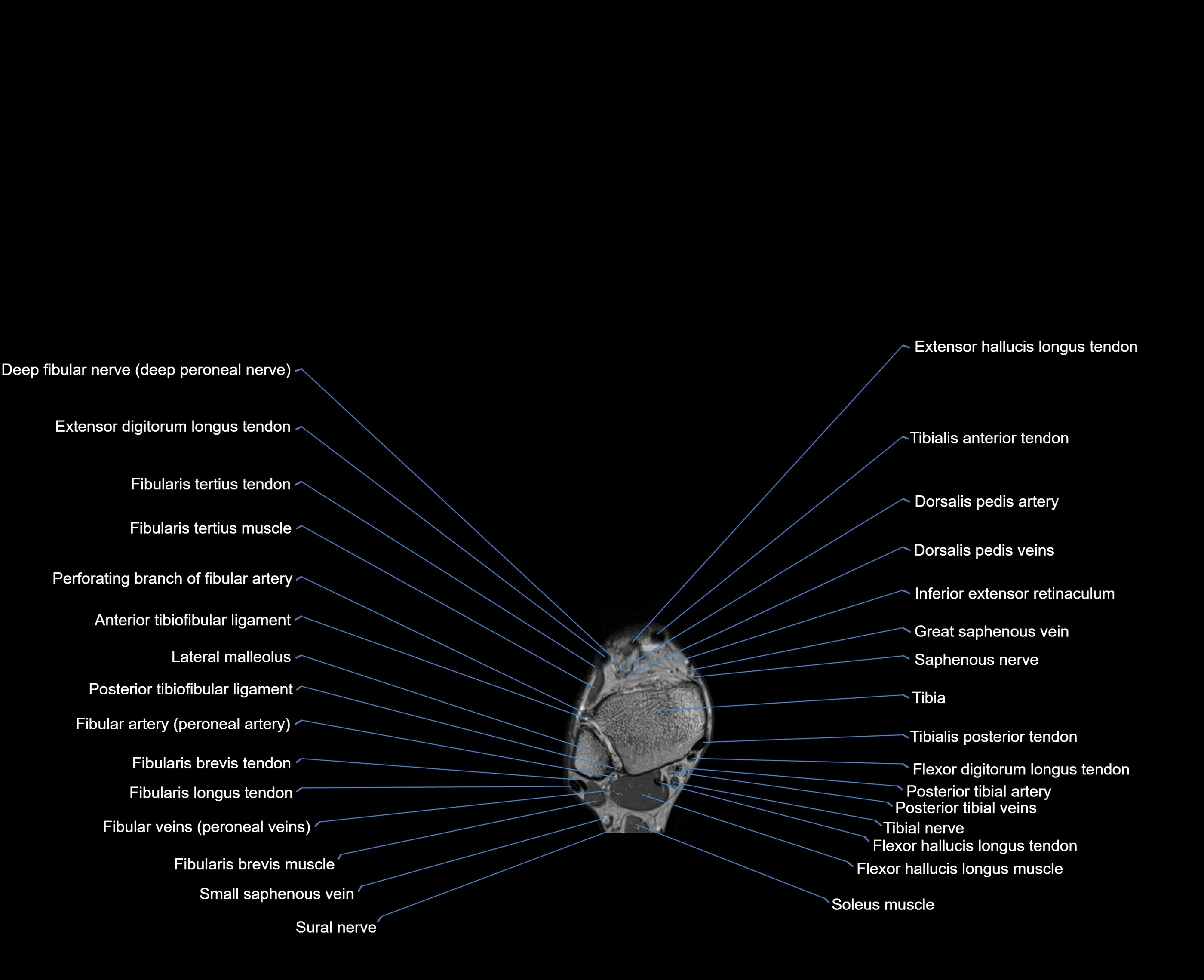 MRI foot coronal cross sectional anatomy 3T  radiology  image-img-00001-00003.webp